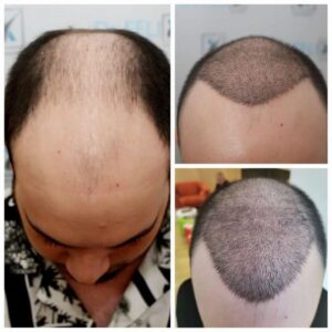 implant-par-dr-felix_81